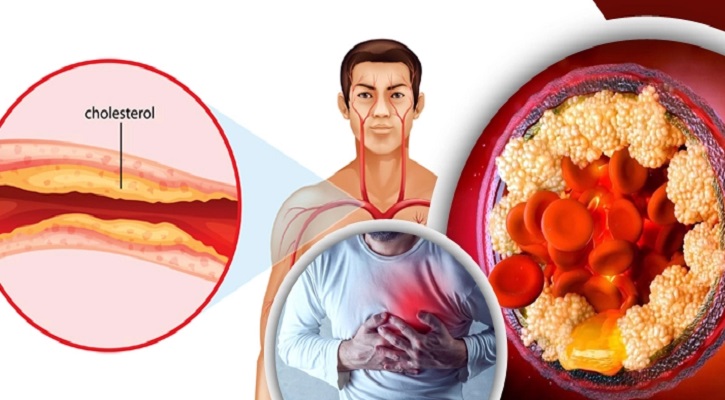 কোলেস্টেরল কী? এ সম্পর্কে আপনার যা কিছু জানা প্রয়োজন