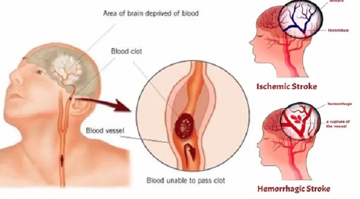 ব্রেইন স্ট্রোক: লক্ষণ, কারণ এবং চিকিৎসা