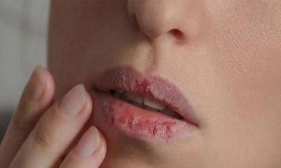 শীত এলেই ঠোঁট ফাটছে? কারণ জানলে মিলবে সহজ সমাধান